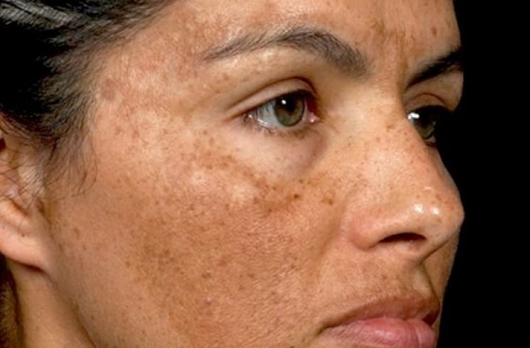 Ilustrasi efek samping garam pada wajah. (Pinterest)