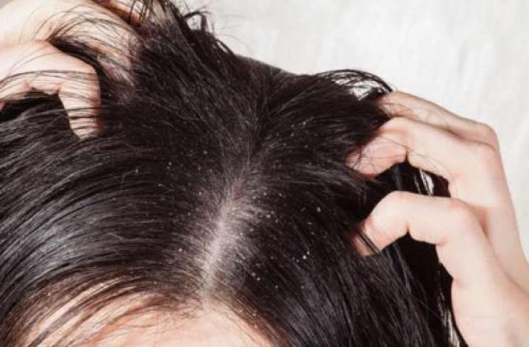 Ilustrasi rambut berketombe. (Shutterstock)