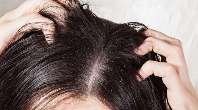 Ilustrasi rambut berketombe. (Shutterstock)