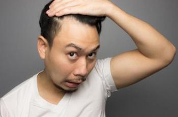 Jangan Galau! Ini Cara Mengatasi Masalah Kebotakan Rambut