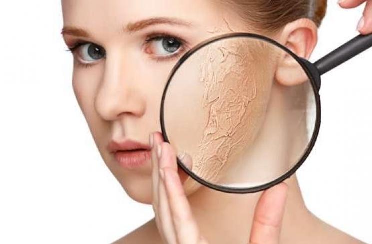 Ilustrasi masalah kulit sensitif. (Shutterstock)