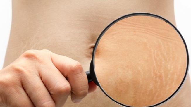 Kulit dengan masalah stretch mark. (Shutterstock)