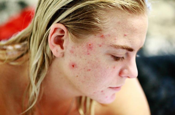 Cara Mengatasi Wajah Bopeng Bekas Jerawat, Manfaatkan 6 Kandungan Skincare Ini