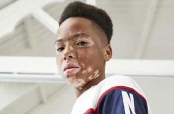Dapat Banyak Pujian, Primark Pakai Model Vitiligo di Kampanye Terbaru