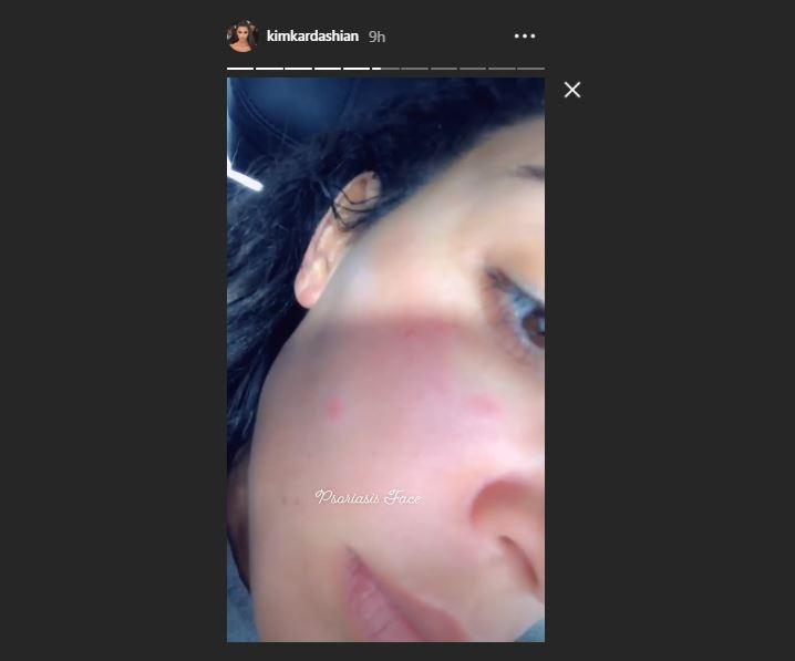Psoriasis di wajah Kim Kardashian. (Instagram/@kimkardashian)