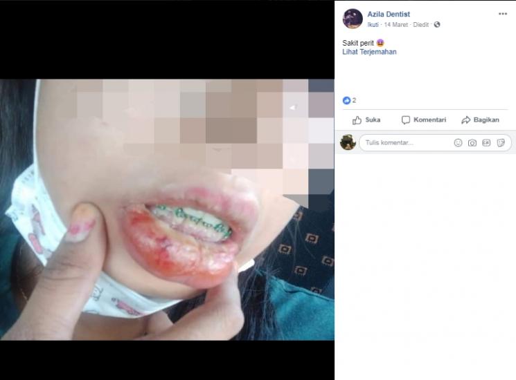 Bibir bengkak karena behel palsu. (Facebook/Azila Dentist)