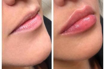Threading Bibir, Tren Kosmetik Non-Bedah untuk Bibir Indah