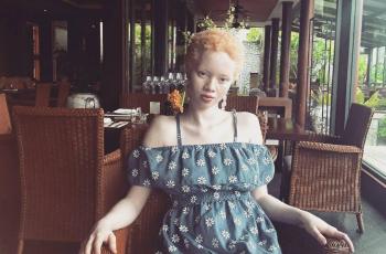 Thando Hopa, Wanita Albino Pertama dalam Sejarah Cover Majalah Vogue