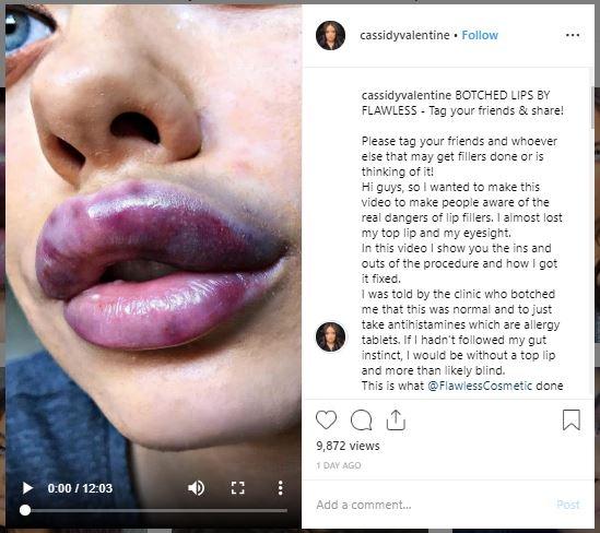 Cassidy Valentine, selebgram yang filler bibir gagal. (Instagram/@cassidyvalentine)