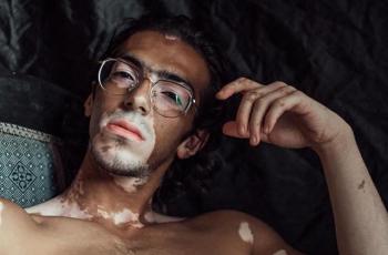 Pria Vitiligo Ini Dulunya Korban Bullying, Kini Jadi Model Menginspirasi