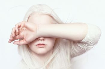 Bikin Takjub! Perhatikan Warna Bola Mata Gadis Albino Ini