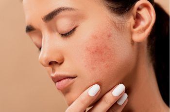 Cari Produk Skincare untuk Mengatasi Jerawat? Perhatikan Kandungan 6 Bahan Aktif Ini