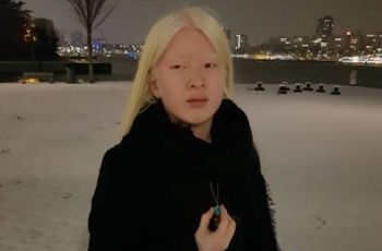 Kisah Model Dibuang Keluarga karena Albinisme, Dianggap Kena Kutukan