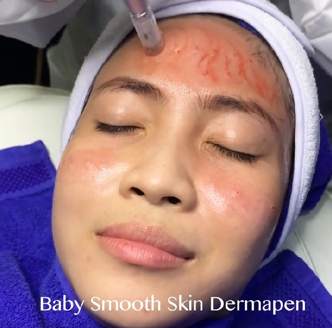 Baby Smooth Skin Dermapen di Marcks Venus Clinic by Kimia Farma. (Istimewa)