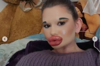 Terobsesi Bibir Besar Mirip Bratz, Wanita Ini Akan Suntik Filler yang ke-27