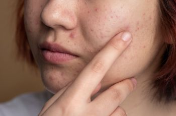 Atasi Jerawat Pakai Acne Patch, Benarkah Justru Bikin Iritasi?