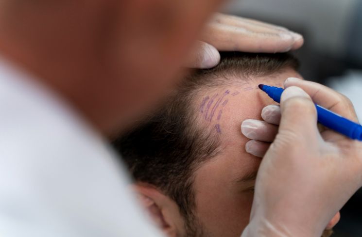 Rambut Rontok Bikin Pria Insecure, Ini Penyebab Utamanya