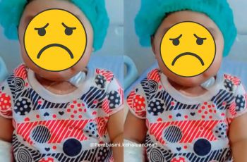 Kisah Bayi Arumi Aghnia Azkayra, Tangannya Harus Diamputasi: Diduga Korban Malpraktik?