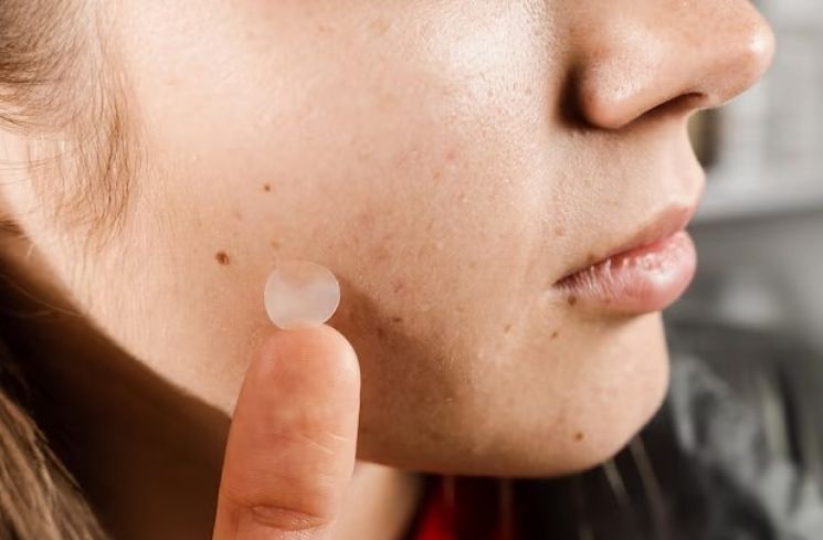 Ilustrasi pakai acne patch. (Freepik)